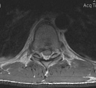 Thoracic Burst MRI Canal Compromise